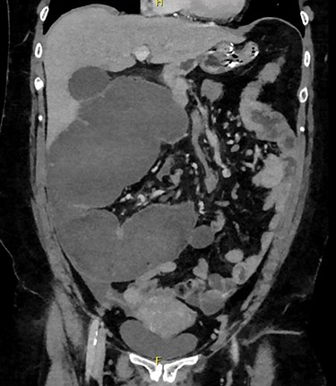 CT—distended loop of caecum in the right upper quadrant.