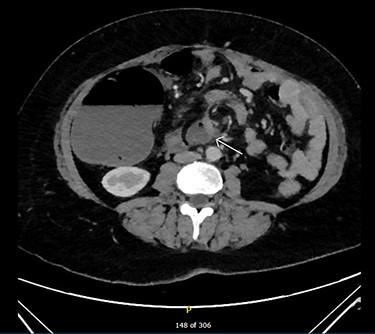 CT—mesenteric whirling (arrow).