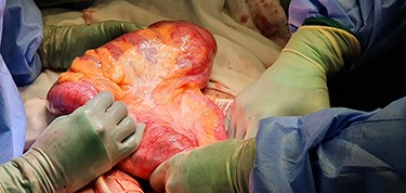 Intra-operative picture: 720 degree axial caecal volvulus with caecal distension.