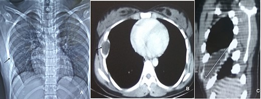 CXR (A, arrow) showing mass lesion in sixth rib. CT chest axial (B, arrow) and saggital (C) showing uniloculated bone cyst.