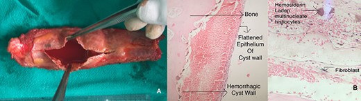 (A) resected specimen of simple bone cyst. (B) Photomicrograph (200×) of rib revealing uniloculated cyst lined by flattened epithelium.