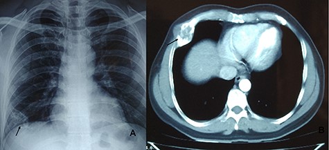CXR showing lytic lesion of right fifth rib (A). CT chest showing well-defined large hypodense cystic lesion of the fifth rib involving anterolateral part (B).