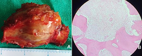 Resected specimen of enchondroma (A). H&E stained 40× photomicrograph suggestive of enchondroma (B).