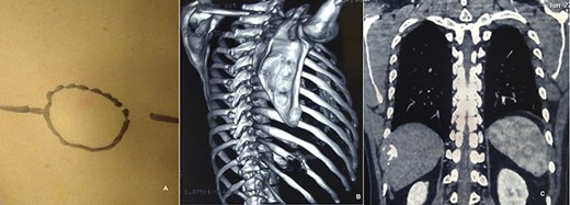 Mass in right posterolateral wall (A). CT chest showing lytic lesion of right tenth rib (B and C).