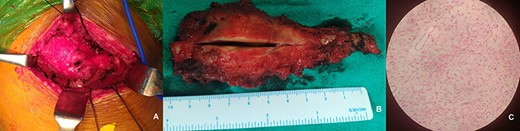 Intra-operative image showing mass in right tenth rib (A). Resected specimen (B). H& E stained 40× photomicrograph of specimen suggestive of fibrous dysplasia (C).