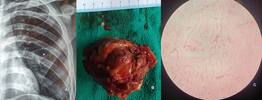 CXR showing mass lesion of left third rib (A, asterisk). Intra-operatice specimen of resected third rib (B). H&E stained 40× photomicrograph of specimen suggestive of aneurismal bone cyst.