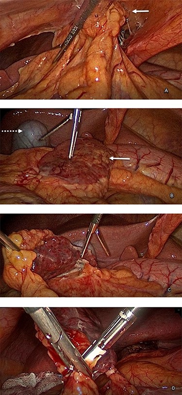 Intraoperative finding, A, the attachment of the omentum to the anterior abdominal wall. B, the white arrow indicates the demarcated dark red color omental infarction compared to the yellow color healthy omentum, and the dotted arrow indicates the gallbladder. C, dissection and excision of the omental infarction. D, excision of the infarcted part of the omentum using a bipolar device.