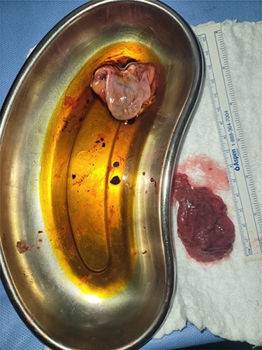 The gallbladder with 8 mm stone opened inside the dish and 5 cm piece of infarcted omentum.