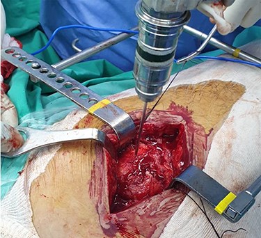 Intraoperative image showing the position of a k-wire in order to indentify the anterior margin of the intramedullary nail.