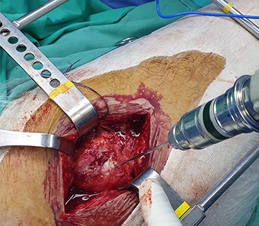 Intraoperative image showing the position of a k-wire in order to indentify the posterior margin of the intramedullary nail.