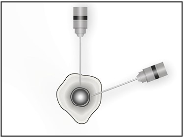 Image showing the metal on metal effect that is produced when the k-wire has reached the outer surface of the nail in different planes.