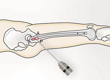 (TAP), is the triangle formed (in red). (T) represents the proximal tip of the intramedullary nail; (A) the anterior margin of the intramedullary nail and (P) the posterior margin of the intramedullary nail.