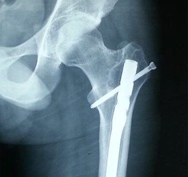 Anteroposterior radiograph showing a buried intramedullary nail.