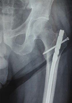 Anteroposterior radiograph showing the tip of the intramedullary nail right at the level of the greater trochanter.
