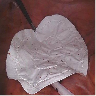 Case 2—laparoscopic picture of Gore-Tex Dual Mesh placed at the pelvic inlet with the microporous smooth side facing the abdominal cavity.