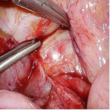 Case 3—small bowel loop adherent to anastomotic recurrence.