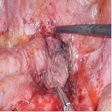 Case 3—unresectable anastomotic recurrence after resection of adherent small bowel.