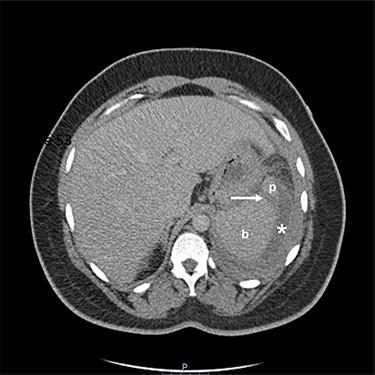 Two-mm axial section from a CT scan showing the perisplenic haematoma (*) and hypodensity (arrow) separating the upper anterior pole of the spleen (p) from the body (b). CT section number 54.