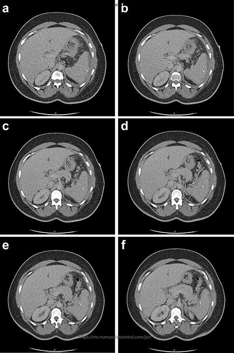 Two-mm axial sections from a CT scan demonstrating the linear hyperdensity traversing the spleen across multiple cross sections. (a) Section number 65 (b) section number 67 (c) section number 69 (d) section number 71 (e) section number 73 (f) section number 75.