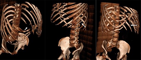Three-dimensional reconstruction CT scan displaying the foreign body (white arrow) in three different orientations.