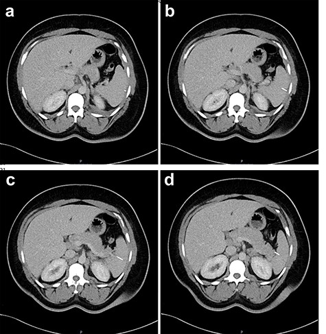 Two-mm axial sections from a CT scan in January 2020, performed after the VATS procedure, to check resolution of the empyema that shows the foreign body impacted in the spleen without evidence of haematoma. (a) section number 18, (b) section number 19, (c) section number 20, (d) section number 21.