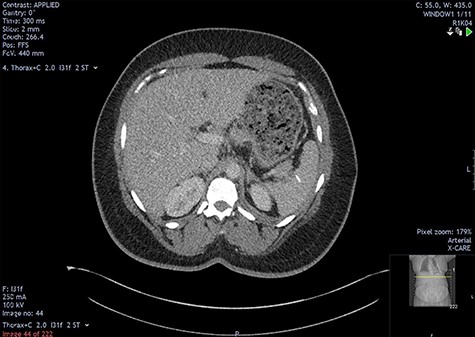 Two-mm axial section from the outpatient CT scan performed in November 2021, demonstrating resolution of the perisplenic haematoma with foreign body in situ.