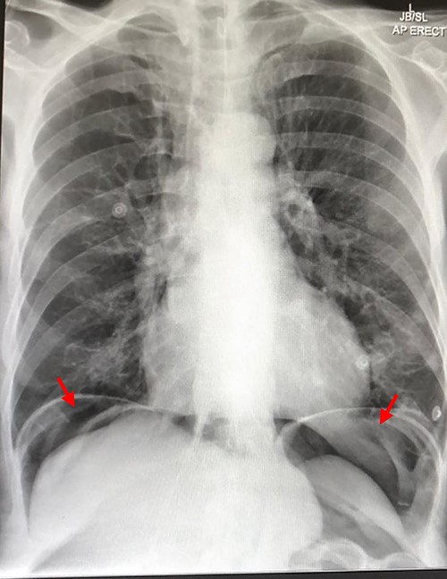 Chest X-ray showing air under the diaphragm suggestive of pneumoperitoneum (red arrows)