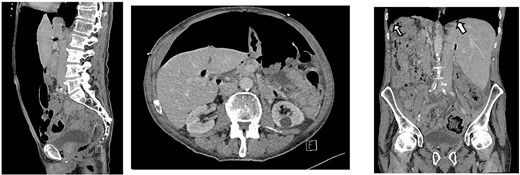 CT scan on initial presentation showing pneumoperitoneum without obvious cause. Sagittal, axial, coronal views. Arrows show pockets of free intraperitoneal air