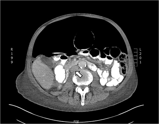 Axial CT showing tension pneumoperitoneum and collapsed inferior vena cava (arrow)
