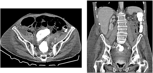 CT showing resolution of the tension pneumoperitoneum post pig-tail insertion and anastomotic integrity—no leakage of contrast