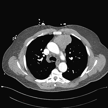 Chest CT angiography revealed a 5.6 × 7.1 × 5.4 cm hypodense mass in the anterior mediastinum involving the adjacent anterior medial left upper lobe.