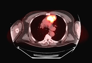 Pre-operative PET scan demonstrating a hypermetabolic anterior mediastinal mass.