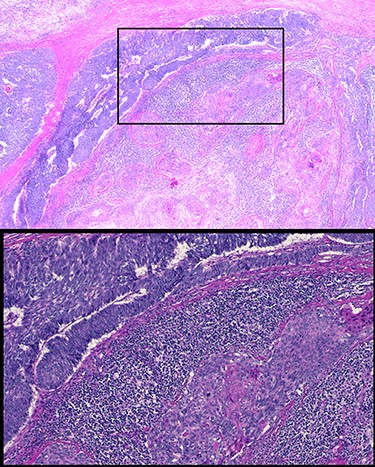 Histology of resected thymic gland with enlarged inset showing palisading and squamous features highly suggestive of basaloid carcinoma.