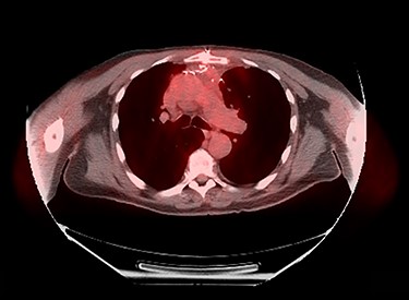 Ten-month post-operative surveillance PET scan demonstrating no evidence of tumor recurrence.