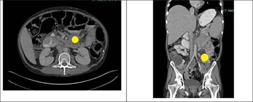 CT abdomen and pelvis with IV contrast showing an ill-defined mass at the root of the mesentery measuring at least 5.2 × 5.1 cm (yellow circle). This was hypothesized to represent conglomerate lymphadenopathy, a potential neoplasm, such as mesothelioma or lymphoma, or metastatic disease. There was also a large volume of abdominal ascites and mildly dilated loops of small bowel within the left abdomen which likely represented a partial obstruction or ileus.