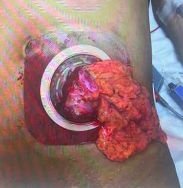 Colostomy site with clear disruption following traumatic fall. Omental fat and a portion of the colon are noted to be eviscerated through the stomal site. The bowel is loose and freely mobile.