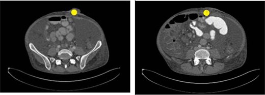 Image taken upon presentation to the emergency department with left lower quadrant ostomy evisceration marked (yellow circle). Oral contrast reaches the mid small bowel. Scattered small bowel loops are mildly prominent measuring up to 3.7 cm in diameter. The colon appears thick-walled particularly along the ascending aspect. There is no pneumatosis. There is no discrete hernia. Findings are consistent with small bowel obstruction.