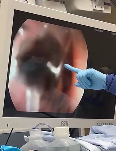 The FB (tree branch) extending from the proximal esophagus to the GEJ.