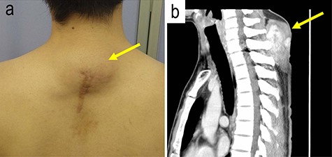 The gross and magnetic resonance imaging (MRI) finding of the tumor; a subcutaneous tumor beneath operation scar was located on the posterior neck of the patient (a); MRI study visualized a mass in the subcutis of the neck (b).