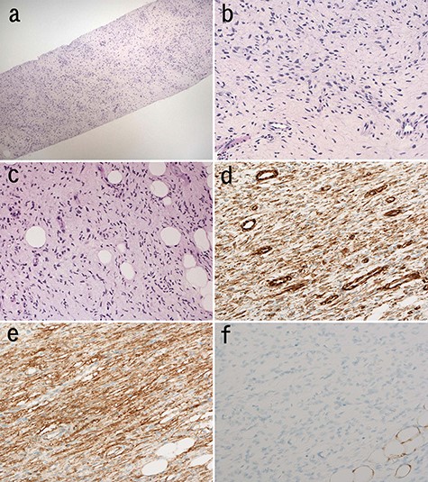 Microscopic findings of the needle biopsy; myxomatous stroma intervened at low magnification of the biopsy; (H&E staining) (a); spindle cells proliferated haphazardly (b); cellular atypia of these cells is mild; (H&E staining) (b); tumor cells infiltrated into adipose tissue in the lesion (c); tumor cells with wavy nuclei were also seen (H&E staining) (c); immunohistochemically, tumor cells were positive for vimentin (d) and CD34 (e) and negative for S-100 (f).