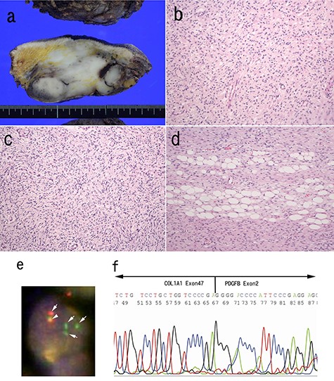 Pathological findings of surgically resected specimen; the cut surface of the tumor was white, solid multinodular mass measuring 83 × 45 mm (a); neurofibroma-like morphology was seen similar to that in the biopsy specimen (H&E staining) (b); cartwheel pattern was observed at tumor periphery (c); tumor cells infiltrated into adipose tissue (H&E staining) (d). FISH analysis for PDGFB gene was conducted (e). The arrows indicate split signals (green and orange) of the PDGFB gene (e). The arrow head indicates intact PDGFB gene (yellow) (e). Sequence analysis of the RT-PCR product from paraffin embedded specimens confirmed the translocation between COL1A1 exon 47 and PDGFB exon 2 (f).