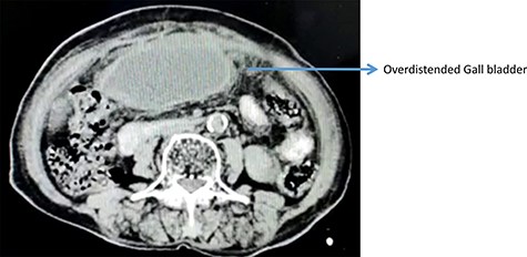 Ultrasonography of abdomen showing over distended GB.
