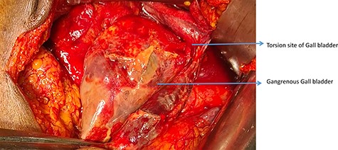 Contrast enhanced computed tomography abdomen showing over distended GB.