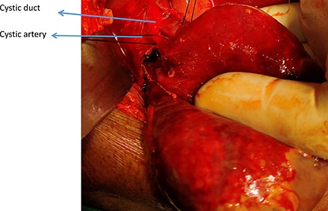 Intraoperative picture showing Torsion site of GB.