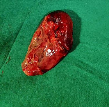 Derotated GB showing Cystic duct and artery.