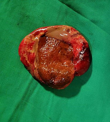 Gross and cut open showing gangrenous mucosa.