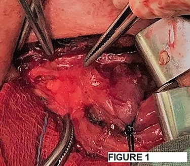 Recognition of the parathyroid gland.