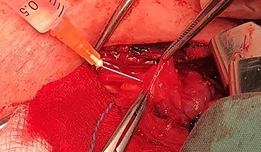 Solution injection with a syringe of 2.5 ml and a needle of 26 gauges, to the loose connective tissue between the thyroid gland capsule and the parathyroid gland.