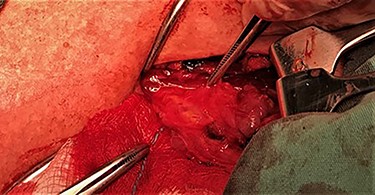 The surgical field after the injection of the solution.