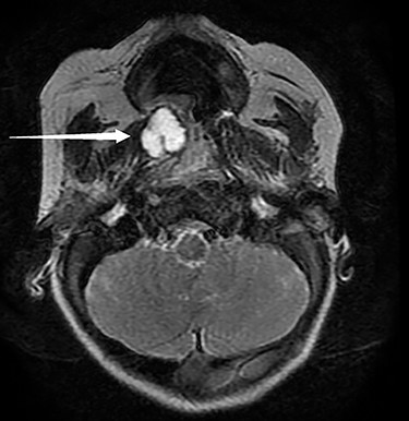Pictured is an MRI displaying a 1.6 × 1.4 × 1.5-cm cystic submucosal mass arising from the right soft palate.
